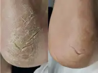 Подологический педикюр, фотография 3