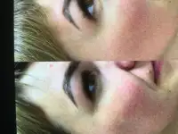 Процедура холодная плазма, фотография 4