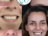 Go To Smile (СТОМАТОЛОГИЧЕСКИЙ ТУРИЗМ) (эстетическая стоматогия в Турции), фотография 4