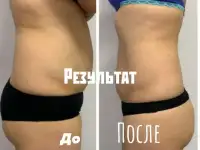 Услуги lpg  массажа