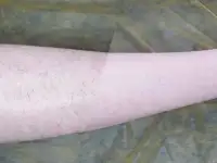 Шугаринг, фотография 4