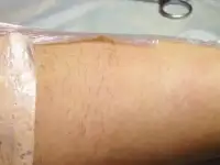 Электроэпиляция с выездом на дом!!!!, фотография 3