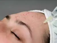 Мезотерапия лица