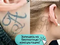 Лазерное удаление татуировок и татуажа/перманента, фотография 3