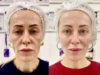 Врач Косметолог. Ботокс, Нити, Губы, фотография 3