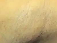 Электроэпиляция