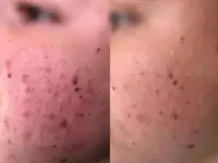 Карбоновый пилинг, фотография 4