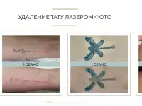 Безболезненное удаление татуировок лазером от 1000 рублей, фотография 3