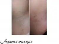 Лазерная эпиляция, РФ-ЛИФТИНГ, КАВИТАЦИЯ,LPG
