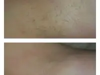 Шугаринг/Восковая депиляция, фотография 5