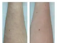 Шугаринг/Восковая депиляция, фотография 6