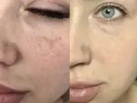 Карбоновый пилинг, фотография 6