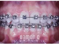 Брекеты Damon Q, фотография 4