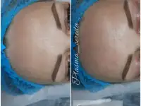 Холодная плазма омоложение лица, фотография 3
