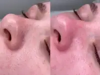 Чистка лица
