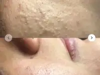 Чистка кожи. Лечение проблемной кожи, фотография 3