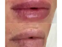Увеличение губ, Juviderm Smile,0,55 ml