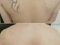 Удаление тату и татуажа, фотография 4
