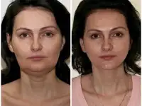Смас лифтинг в Москве., фотография 4
