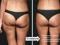 Вакуумно-роликовый и баночный массаж, фотография 5