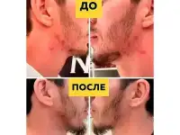 Освободите кожу от прыщей Silver Shein, фотография 6