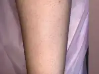 Лазерная эпиляция, фотография 4
