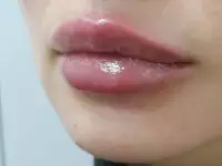 Увеличение губ, Juviderm Smile,0,55 ml, фотография 4