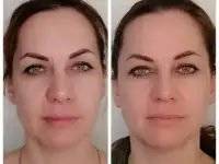 Естественное омоложение. Витапластика, фотография 6