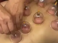 Оздоровительный массаж. Хиджама. Гирудотерапия, фотография 6