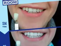 Косметическое отбеливание зубов, фотография 2