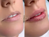 Увеличение губ