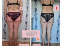 Коррекция фигуры. Липосакция карамельная. Лифтинг, фотография 7
