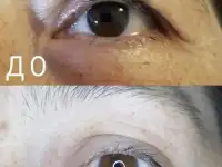 Омоложение лица без операций, фотография 2