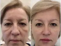 Смас лифтинг в Москве., фотография 3
