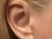 Омоложение лица без операций, фотография 3