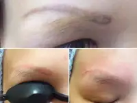 Лазерное удаление татуировок и татуажа в СВАО, фотография 6