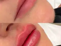 Увеличение губ, фотография 4
