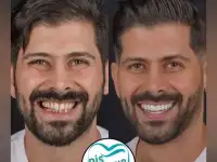 Go To Smile (СТОМАТОЛОГИЧЕСКИЙ ТУРИЗМ) (эстетическая стоматогия в Турции), фотография 7