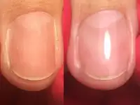 Медицинский педикюр, фотография 9