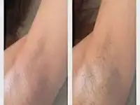 Шугаринг, фотография 7