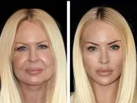 Модели на Подтяжку лица у Косметологабез уколов, фотография 4