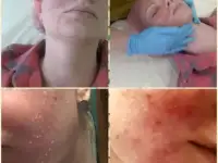 пиллинг жёлтый, фотография 3