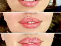 Врач Косметолог. Ботокс, Нити, Губы, фотография 10