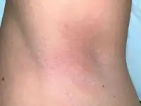 Электроэпиляция 10 р., фотография 2