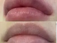 Увеличение губ, Juviderm Smile,0,55 ml, фотография 3