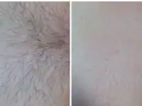Шгаринг депилиляция, фотография 2