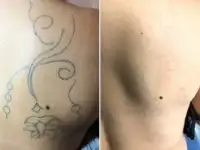 Удаление тату и татуажа, фотография 2