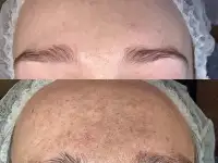 Чистка кожи. Лечение проблемной кожи, фотография 2