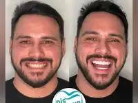 Go To Smile (СТОМАТОЛОГИЧЕСКИЙ ТУРИЗМ) (эстетическая стоматогия в Турции), фотография 8