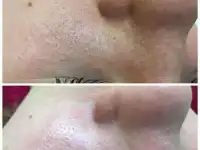 3Д чистка лица/дермабразия, фотография 2